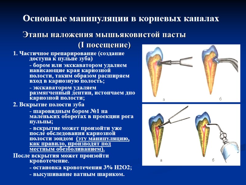Этапы наложения мышьяковистой пасты (I посещение) 1. Частичное препарирование (создание доступа к пульпе зуба)